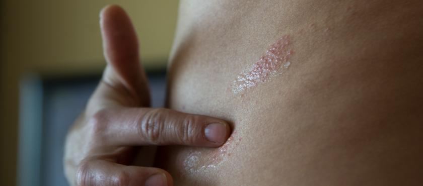 main of A Case of Shingles in Incredibly Painful and Unpleasant