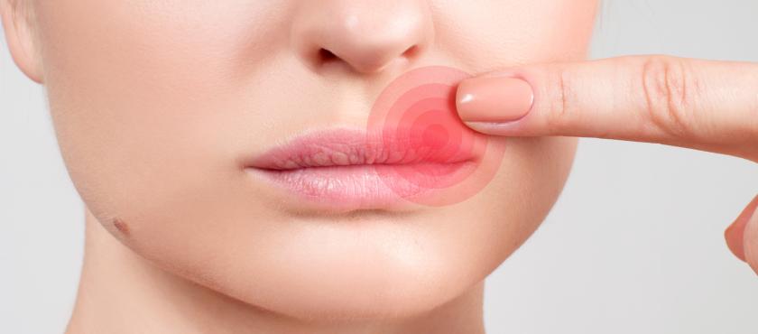 main of The Cold Sore is One of the Most Common Viral Infections