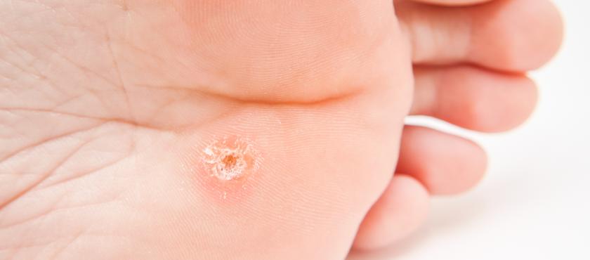 main of Painless Wart Removal Treatments