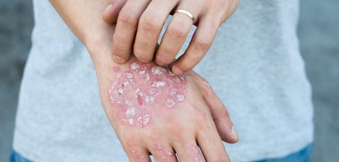 thumbnail of How to Treat Fungal Infections