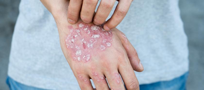 main of How to Treat Fungal Infections