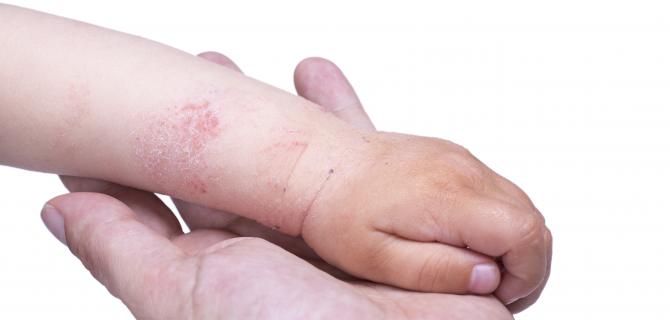 thumbnail of Know the Facts About Eczema and Dermatitis! 