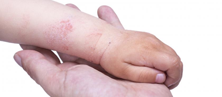 main of Know the Facts About Eczema and Dermatitis! 