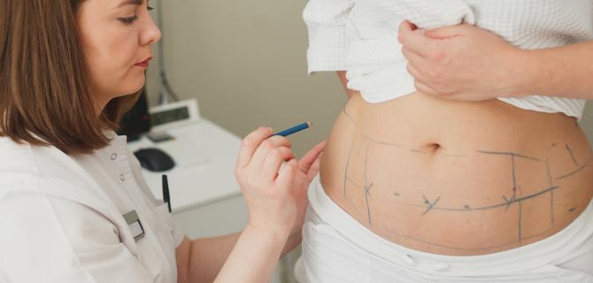 thumbnail of Considering Liposuction or an Abdominoplasty? What You Should Know