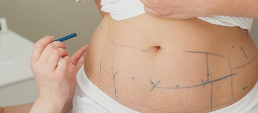 main of Considering Liposuction or an Abdominoplasty? What You Should Know