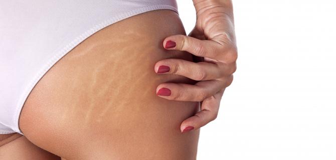 thumbnail of Try Reducing Scar Tissue and Stretch Marks Naturally