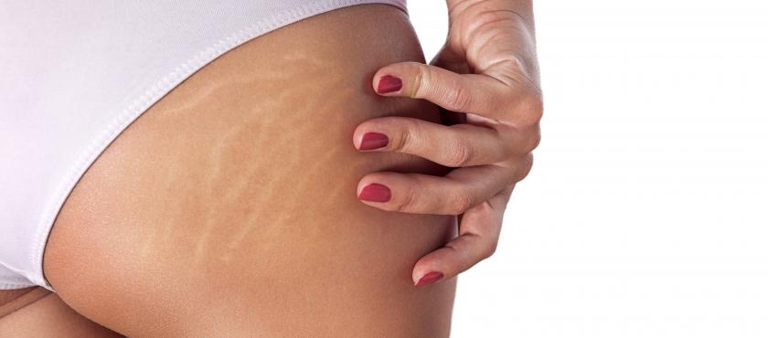main of Try Reducing Scar Tissue and Stretch Marks Naturally