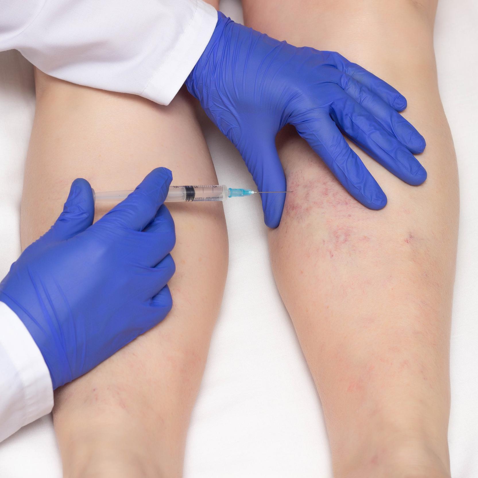 banner of Getting Rid of Spider Veins Means Turning to Sclerotherapy (healthychoice)