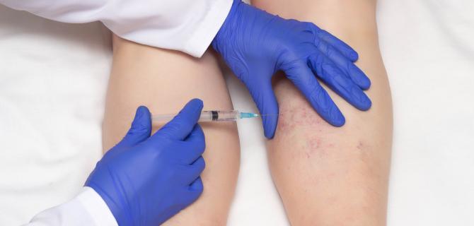 c-thumbnail of Getting Rid of Spider Veins Means Turning to Sclerotherapy (healthychoice)