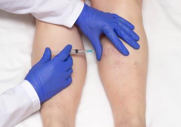 h-thumbnail of Getting Rid of Spider Veins Means Turning to Sclerotherapy (healthychoice)