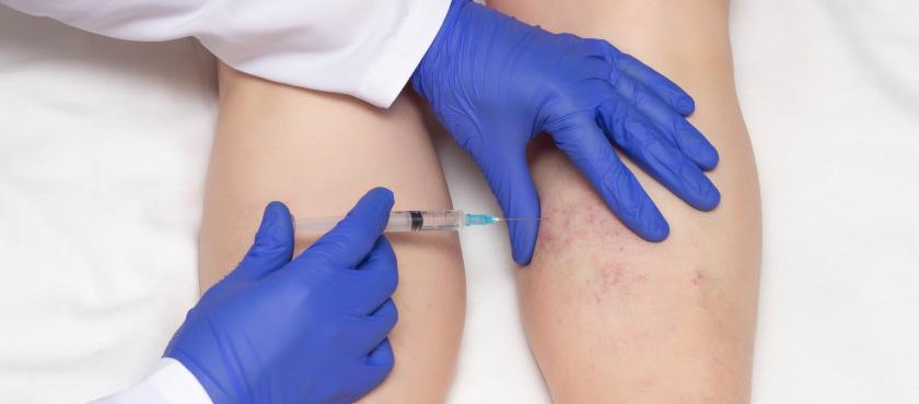 main of Getting Rid of Spider Veins Means Turning to Sclerotherapy (healthychoice)